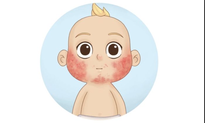baby eczema